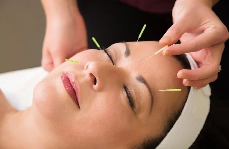 Xác định huyệt Dương Bạch và thực hiện kích thích bằng kim châm cứu