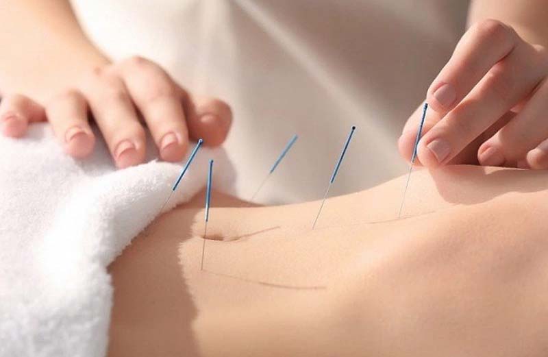 Châm cứu huyệt Đại Hoành bởi các bác sĩ Đông y tay nghề cao