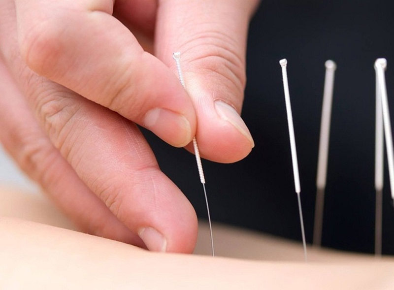 Huyệt Lao Cung được ứng dụng trong châm cứu