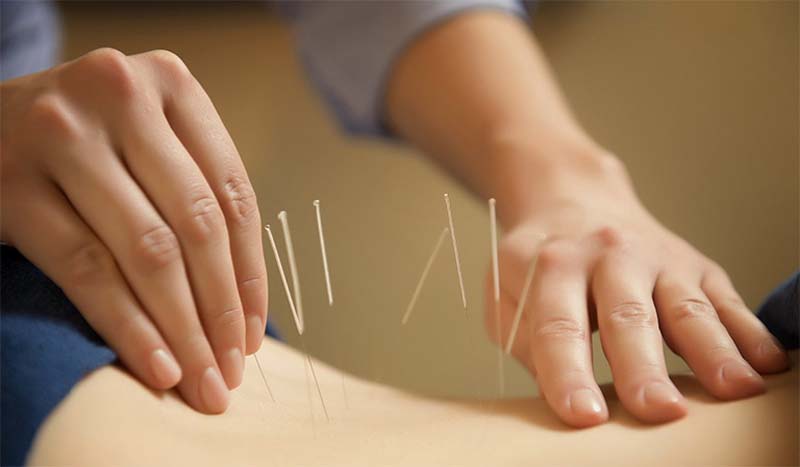 Châm cứu tác động kích thích huyệt Vị Du
