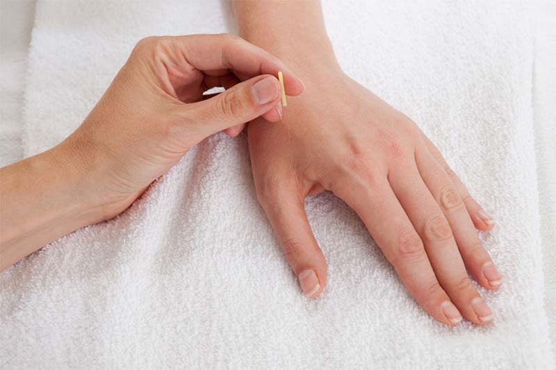 Châm cứu huyệt Hợp Cốc được thực hiện bởi chuyên gia