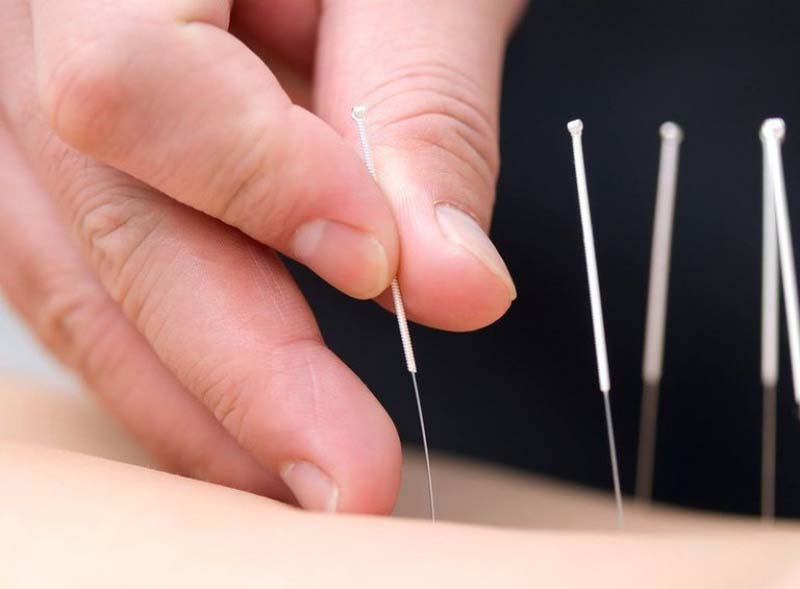 Châm cứu huyệt Khúc Cốt là kỹ thuật Đông y nâng cao