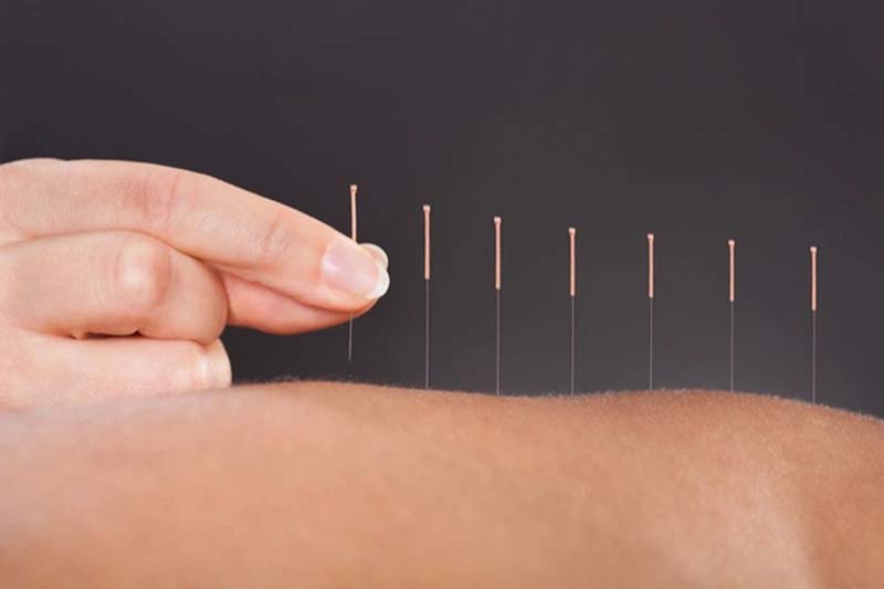 Châm cứu huyệt Chương Môn là kỹ thuật nâng cao
