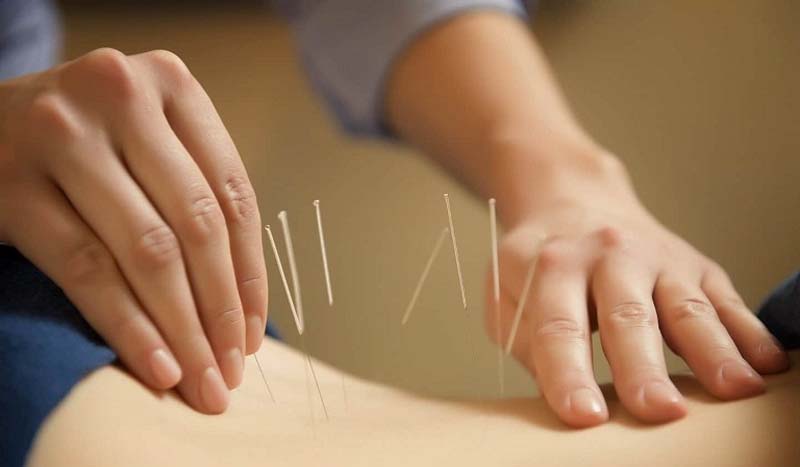Châm cứu huyệt Yêu Dương Quan nhằm điều trị các bệnh lý mãn tính