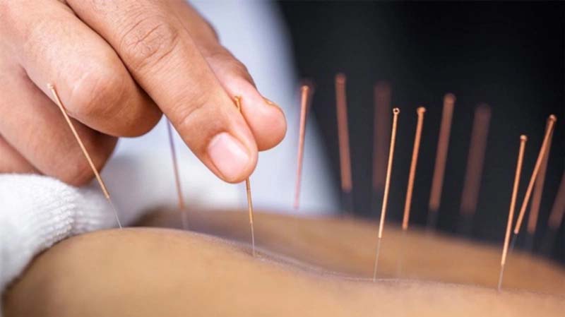 Thực hiện châm cứu huyệt Kỳ Môn với kỹ thuật nâng cao
