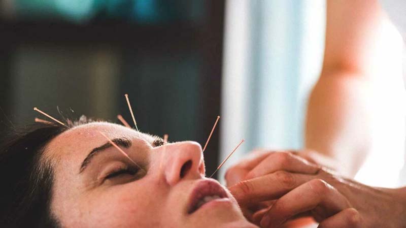 Châm cứu huyệt Tình Minh được thực hiện bởi chuyên gia
