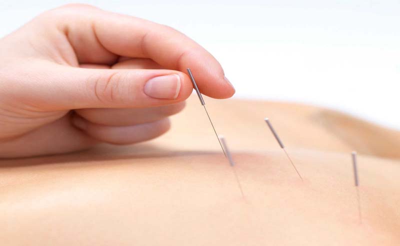 Cẩn trọng khi châm cứu huyệt Thiên Trì để tránh tai biến