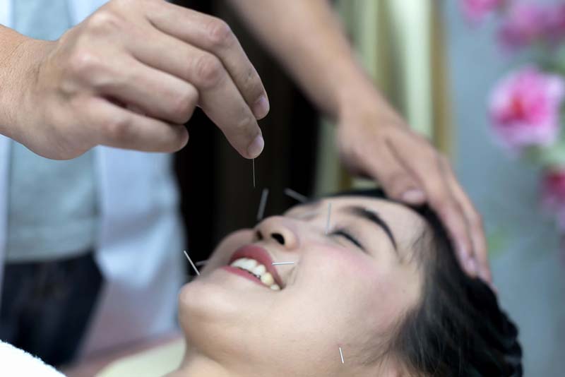 Bác sĩ thực hiện châm cứu huyệt ở Thái Dương kết hợp các huyệt khác trên mặt