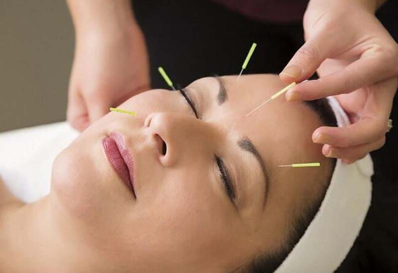 Châm cứu huyệt Ngư Yêu với kỹ thuật nâng cao