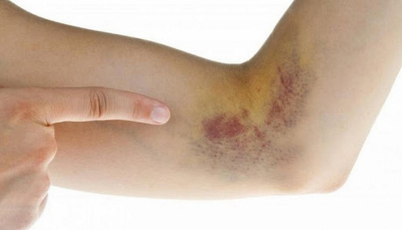 Bầm tím do bấm huyệt tại tay quá mức