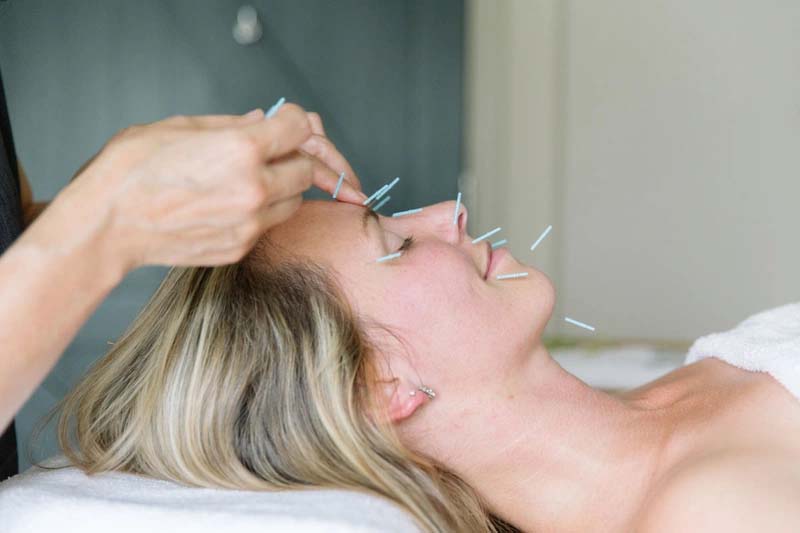 Châm cứu - cách tốt nhất phát huy tác dụng huyệt Nghinh Hương