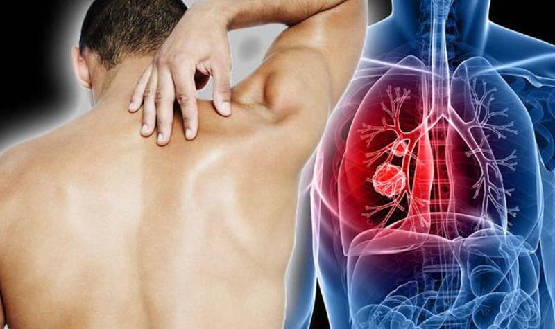 Ung thư phổi với các cơn đau đau nhói sau lưng trên bên phải hoặc trái kèm hô hấp khó khăn