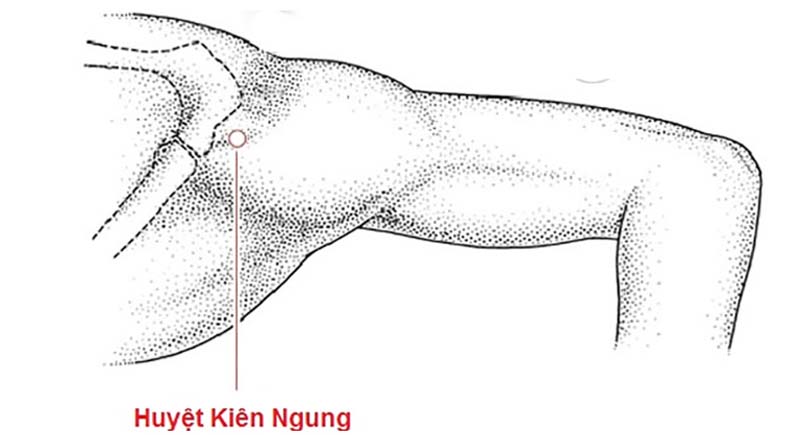 Huyệt Kiên Ngung vị trí nằm trên vai ngay gần xương đòn