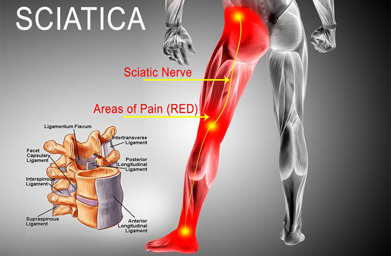 Tổng hợp các loại máy massage hỗ trợ điều trị đau thần kinh tọa