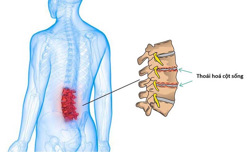 Thóa hóa cột sống gây ra các cơn đau lưng dữ dội khi mới ngủ dậy