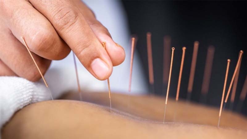 Kết hợp châm cứu huyệt Liêm Tuyền và các huyệt vị khác để tăng cường tác dụng chữa bệnh