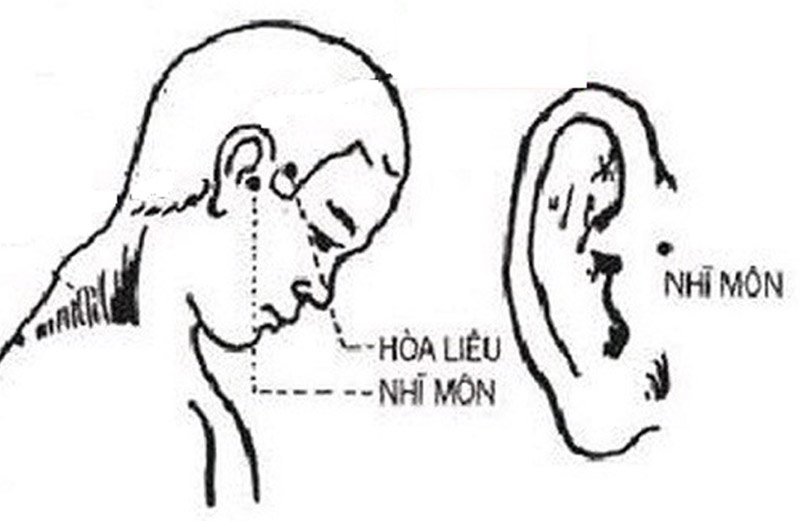 Vị trí huyệt Nhĩ Môn chữa ù tai