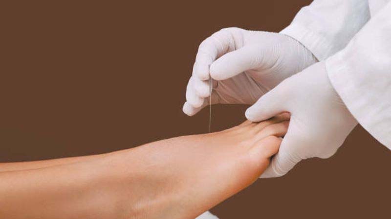 Châm cứu huyệt Nội Đình điều trị các bệnh lý mãn tính