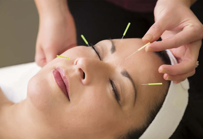 Châm cứu huyệt Quyền Liêu kết hợp cùng các huyệt vị khác trên khuôn mặt