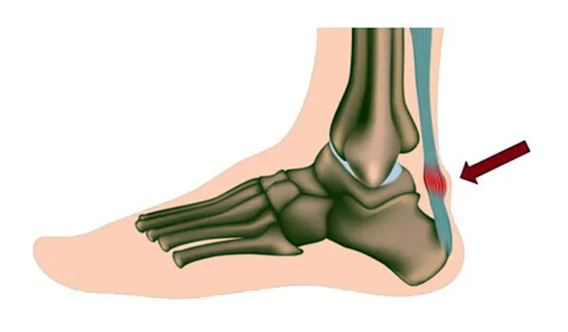Huyệt Côn Lôn: Vị trí, tác dụng và cách châm cứu bấm huyệt