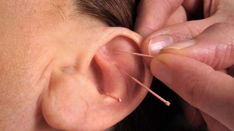 Nhĩ Châm là gì? Ứng dụng và những lưu ý quan trọng