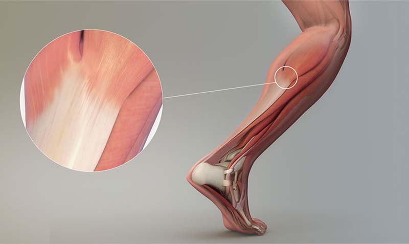 Đau cơ bắp chân: Nguyên nhân, cách điều trị và phòng ngừa