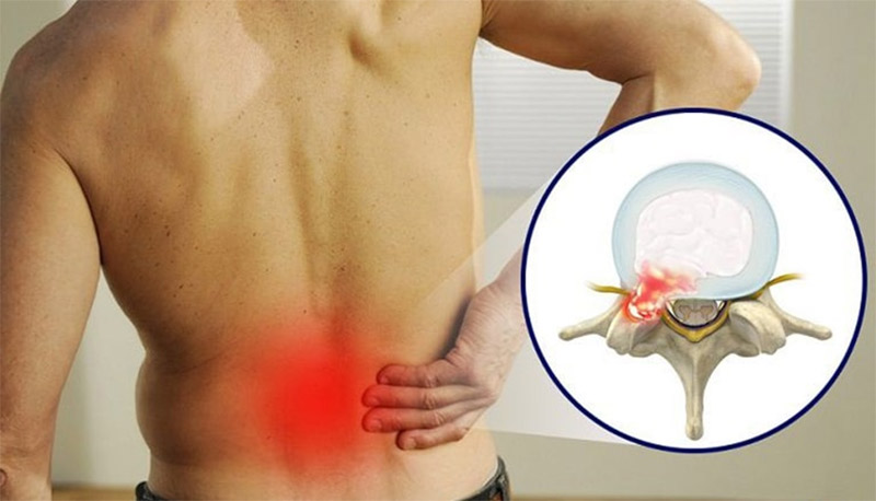 Thoát vị đĩa đệm: Nguyên nhân, triệu chứng và cách điều trị hiệu quả
